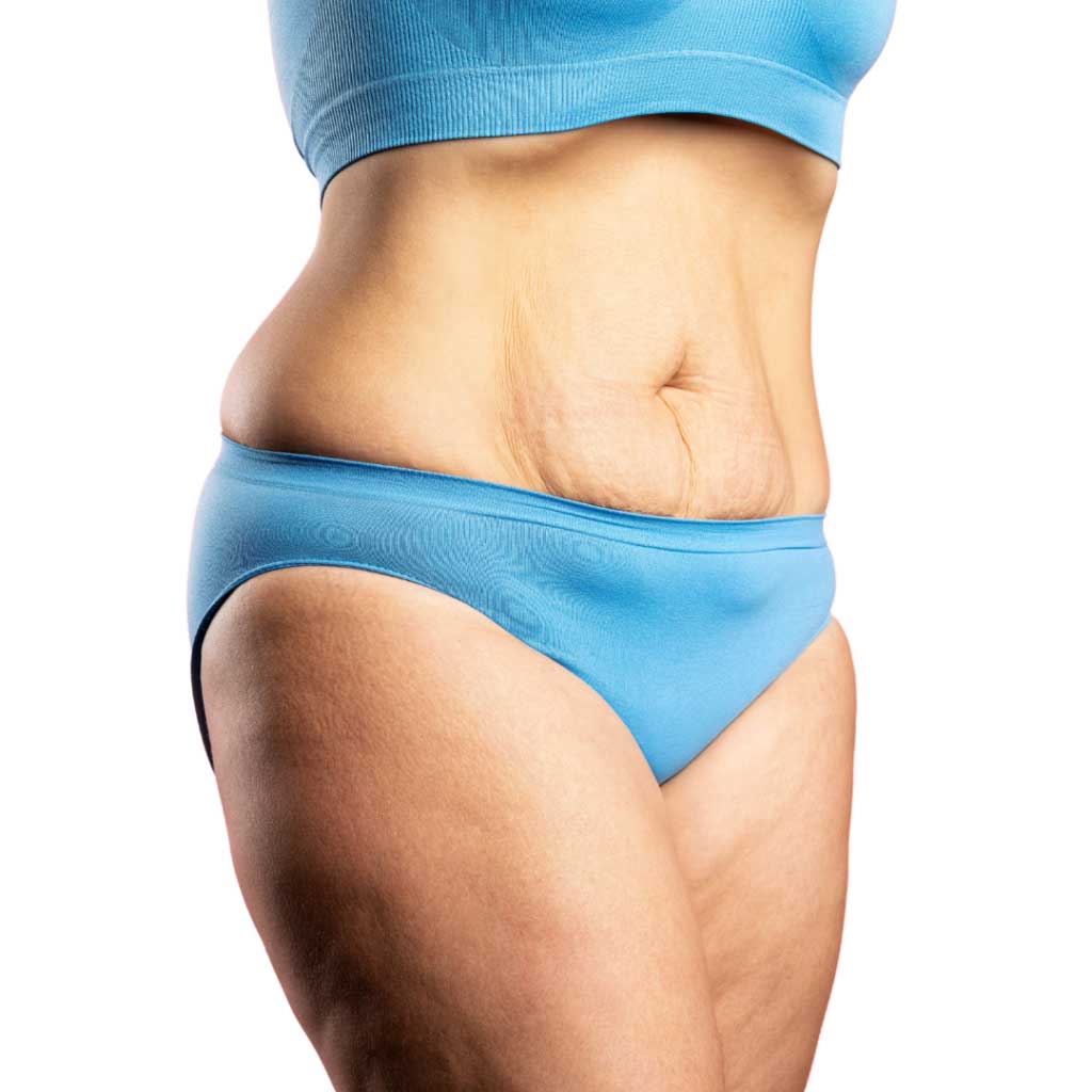 Vorberg Beauty Clinics Bauchdeckenstraffung Vorberg Beauty Clinics Bauchdeckenstraffung