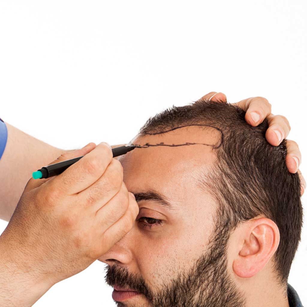 Vorberg Beauty Clinics Haartransplantation Vorberg Beauty Clinics Haartransplantation