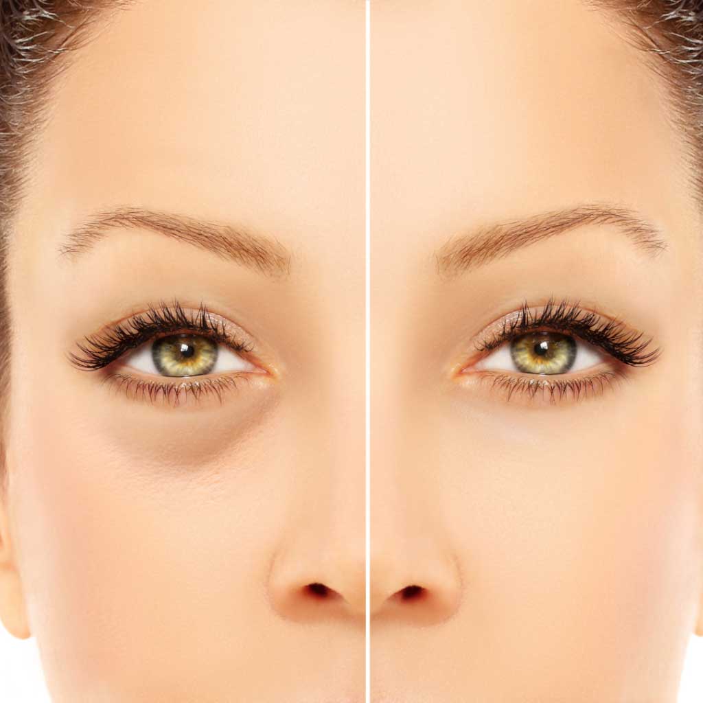 Vorberg Beauty Clinics Oberlidstraffung
